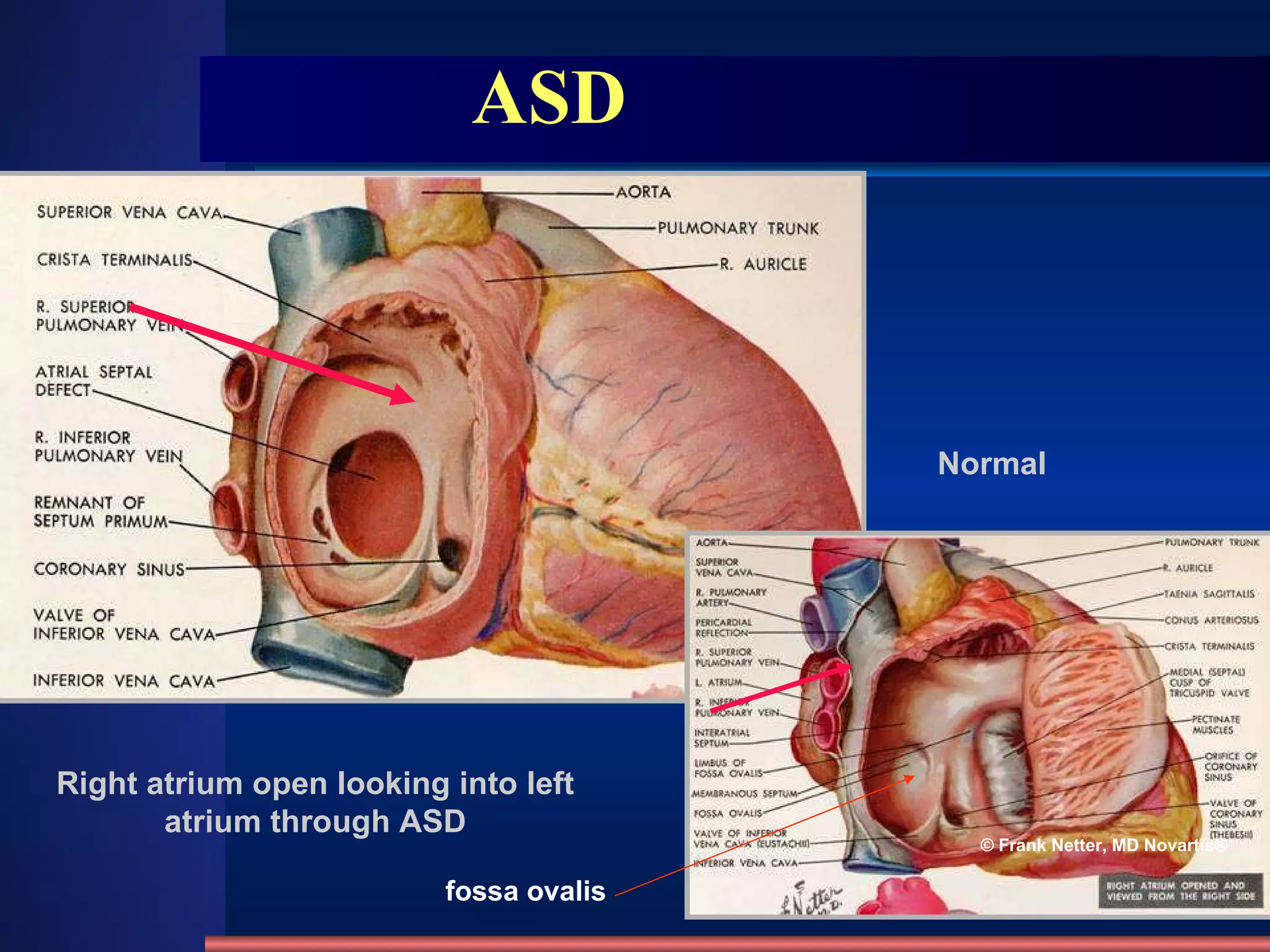 ASD Right atrium open looking into left atrium through ASD Normal © Frank Netter, MD Novartis® fossa ovalis   