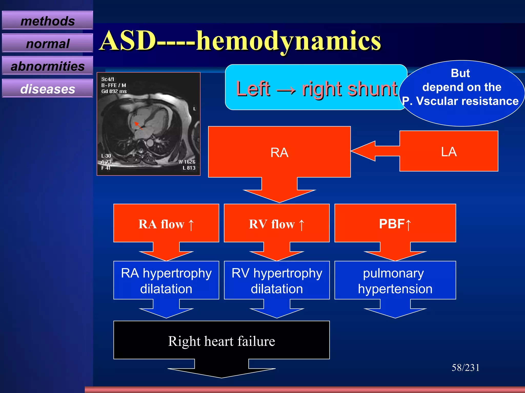 ASD----hemodynamics /231 Left -> right shunt But  depend on the P. Vscular resistance  RA LA RA flow  ↑ RV flow  ↑ PBF↑ RA hypertrophy dilatation RV hypertrophy dilatation pulmonary  hypertension Right heart failure methods normal abnormities diseases 