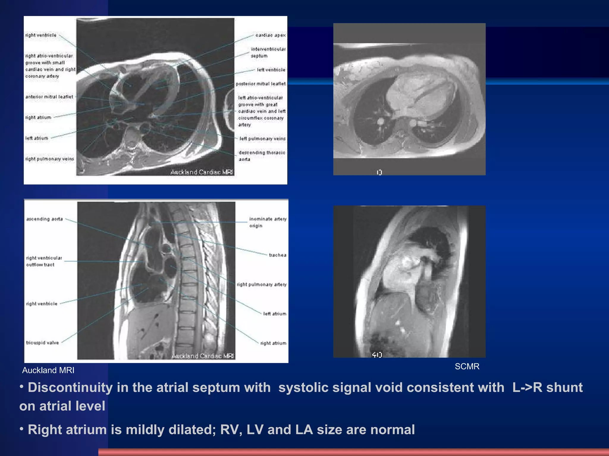 Discontinuity in the atrial septum with  systolic signal void consistent with  L->R shunt on atrial level  Right atrium is mildly dilated; RV, LV and LA size are normal SCMR Auckland MRI 