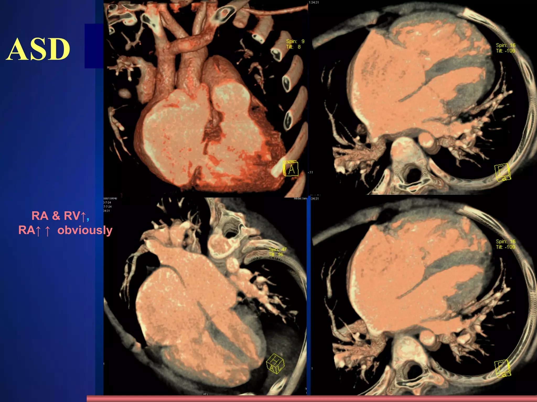 ASD RA & RV↑ ,  RA↑ ↑   obviously 