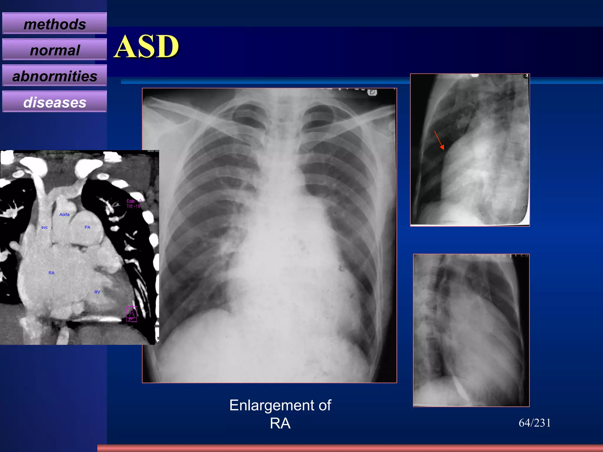 ASD /231 Enlargement of RA methods normal abnormities diseases RA RV PA Aorta svc 
