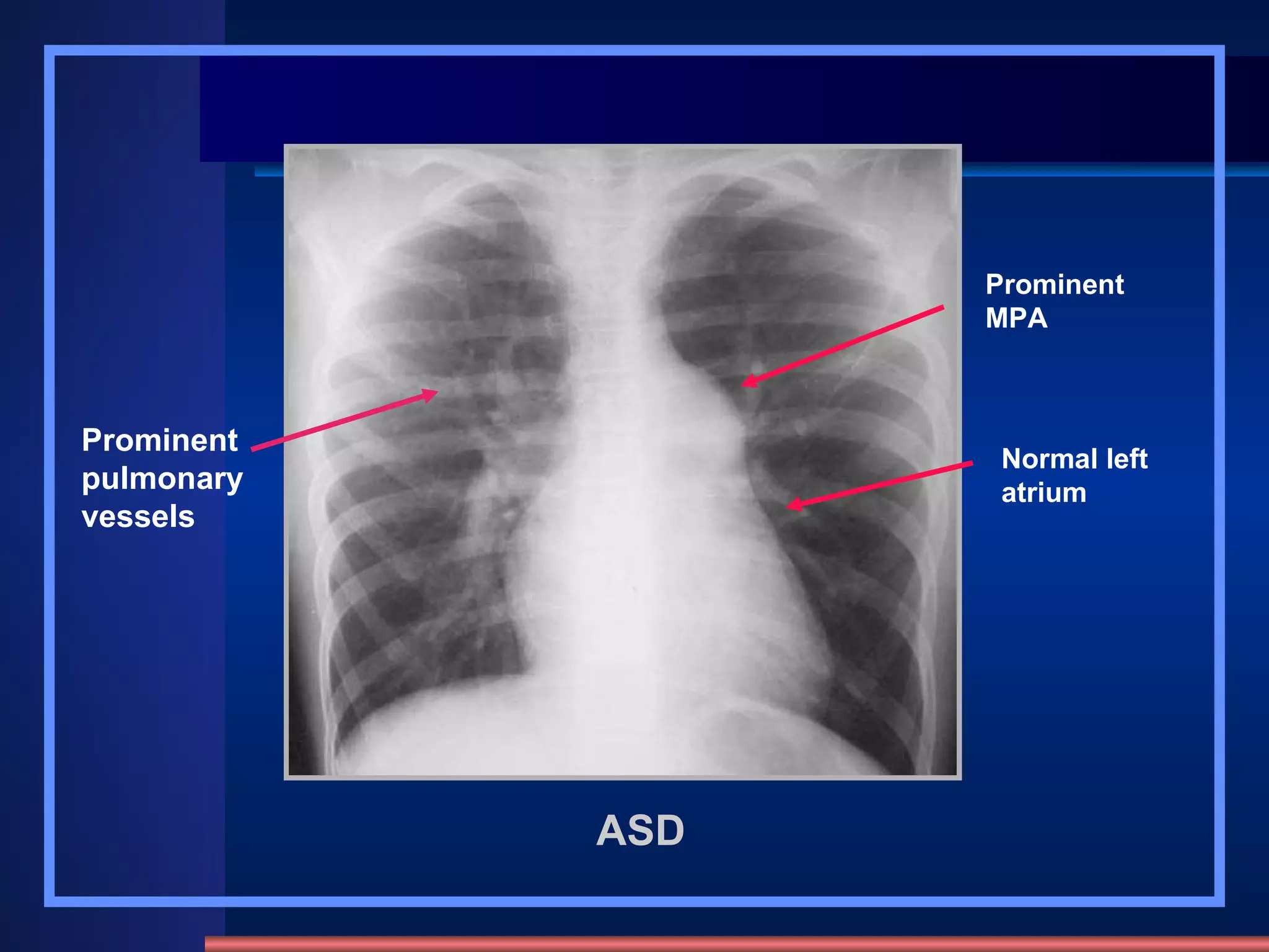 ASD Prominent pulmonary vessels Prominent MPA Normal left atrium 