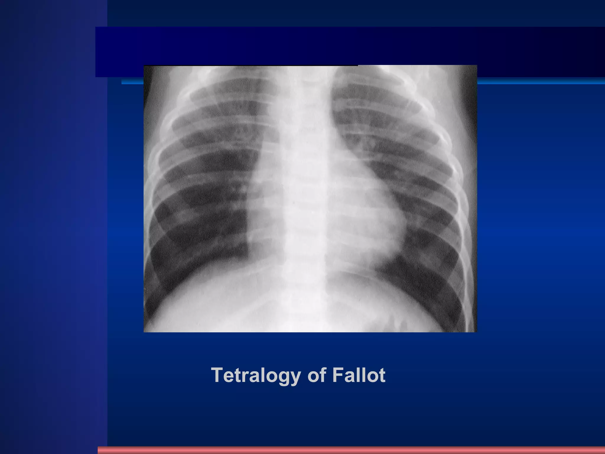 Tetralogy of Fallot 