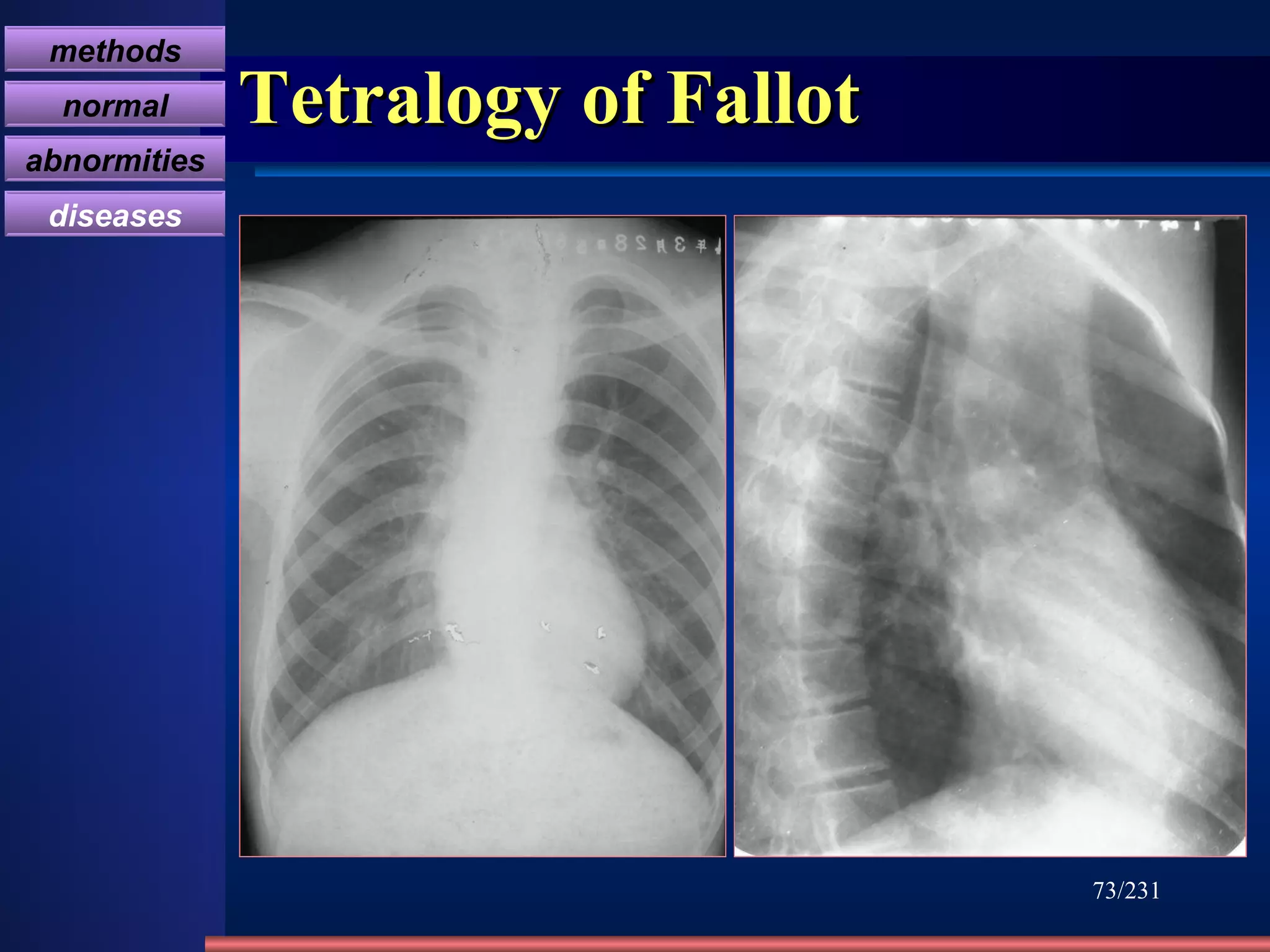 Tetralogy of Fallot /231 methods normal abnormities diseases 