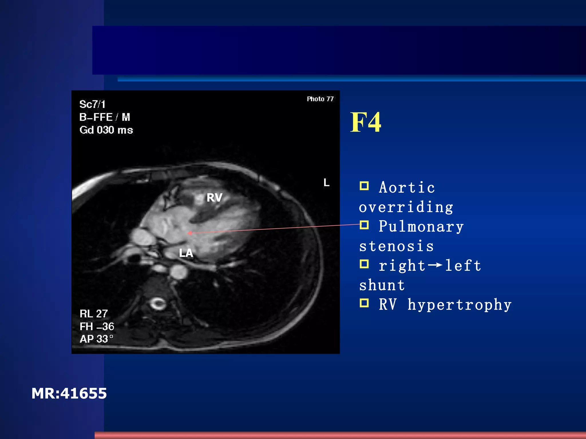 F4 Aortic overriding Pulmonary stenosis right->left shunt RV hypertrophy LA RV MR:41655 