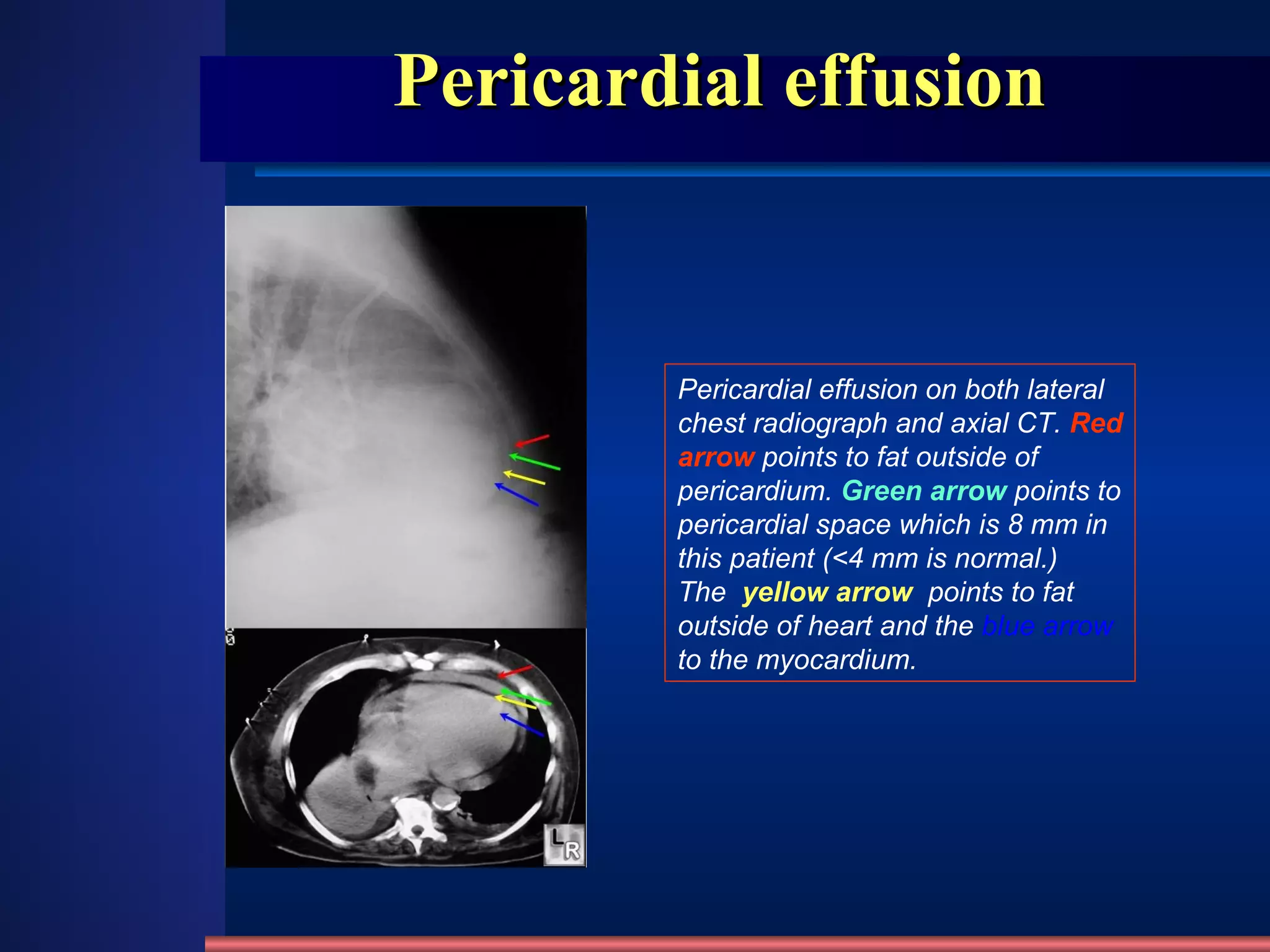 Pericardial effusion Pericardial effusion on both lateral chest radiograph and axial CT.  Red arrow  points to fat outside of pericardium.  Green arrow   points to pericardial space which is 8 mm in this patient (<4 mm is normal.)  The   yellow arrow    points to fat outside of heart and the  blue arrow  to the myocardium. 