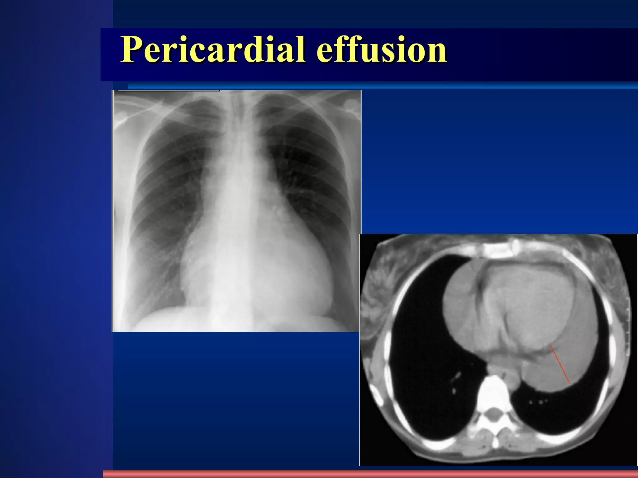 Pericardial effusion 