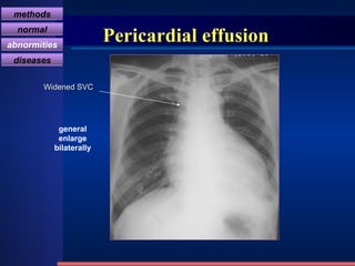 Pericardial effusion general enlarge bilaterally Widened SVC methods normal abnormities diseases 