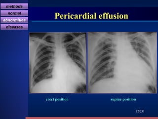 Pericardial effusion /231 erect position  supine position methods normal abnormities diseases 