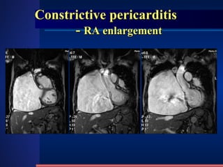 Constrictive pericarditis   -  RA enlargement 