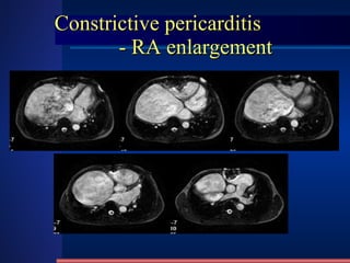 Constrictive pericarditis   - RA enlargement 