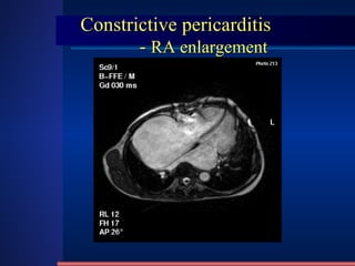 Constrictive pericarditis   -  RA enlargement 