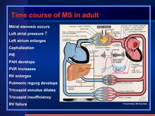 Mitral stenosis occurs  Left atrial pressure     Left atrium enlarges  Cephalization  PIE  PAH develops  PVR increases  RV enlarges  Pulmonic regurg develops  Tricuspid annulus dilates  Tricuspid insufficiency  RV failure Time course of MS in adult © Frank Netter, MD Novartis® 
