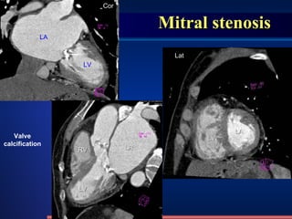 Mitral stenosis LA LV RV LA LV LV LA Valve calcification Lat Cor  