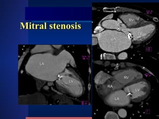 Mitral stenosis LA LV LA LV LA RV LV RA RV 