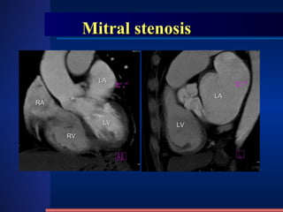 Mitral stenosis LA LV LV LA RV RA 