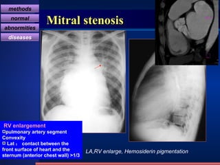 Mitral stenosis LA,RV enlarge, Hemosiderin pigmentation RV enlargement pulmonary artery segment Convexity Lat ： contact between the front surface of heart and the sternum (anterior chest wall) >1/3   methods normal abnormities diseases 
