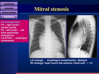 Mitral stenosis LA enlarge ： esophagus compression, diplopia RV enlarge: heart touch the anterior chest wall  ＞ 1/3 LA enlargement PA – right border ： double density PA – left border ： left atrial appendage enlargement Lat & RAO ： esophagus compressed methods normal abnormities diseases 
