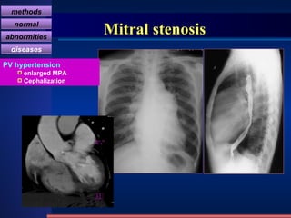 Mitral stenosis PV hypertension enlarged MPA Cephalization methods normal abnormities diseases 