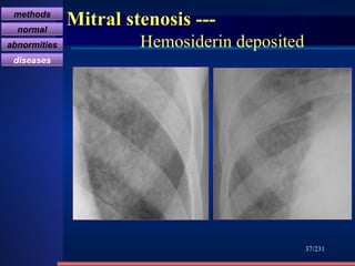 Mitral stenosis ---    Hemosiderin deposited /231 methods normal abnormities diseases 