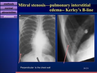 Mitral stenosis—pulmonary interstitial   edema-- Kerley’s B-line /231 Perpendicular  to the chest wall methods normal abnormities diseases 