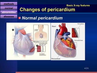 Basic X-ray features Changes of pericardium Normal pericardium /231 methods normal abnormities diseases 
