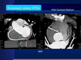 Coronary artery CTA MIP With Contrast Medium 