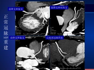 前降支和旋支 前降支和对角支 前降支和旋支 心底部冠脉供血 正常冠脉 MIP 重建 