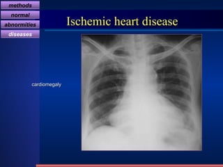 Ischemic heart disease cardiomegaly methods normal abnormities diseases 