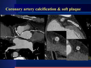 Coronary artery calcification & soft plaque 