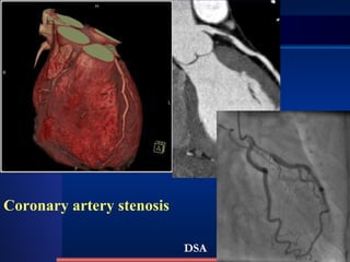 Coronary artery stenosis DSA 