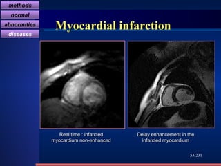 Myocardial infarction /231 Real time : infarcted myocardium non-enhanced Delay enhancement in the infarcted myocardium methods normal abnormities diseases 