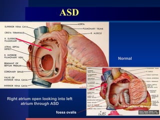 ASD Right atrium open looking into left atrium through ASD Normal © Frank Netter, MD Novartis® fossa ovalis   