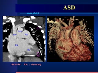 ASD aorta shrink RA & RV↑ ,  RA↑ ↑   obviously RA RV PA Aorta svc 