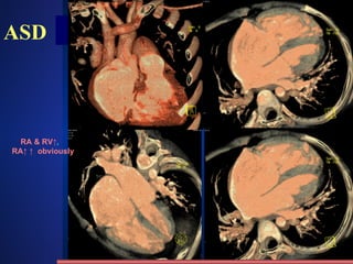ASD RA & RV↑ ,  RA↑ ↑   obviously 