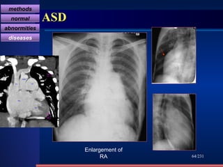 ASD /231 Enlargement of RA methods normal abnormities diseases RA RV PA Aorta svc 