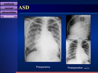 ASD /231 Preoperative Postoperative methods normal abnormities diseases 