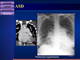 ASD /231 Pulmonary hypertension methods normal abnormities diseases RA RV PA Aorta svc 