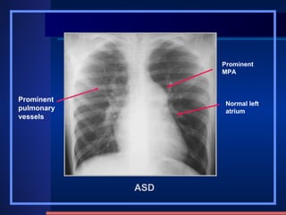ASD Prominent pulmonary vessels Prominent MPA Normal left atrium 