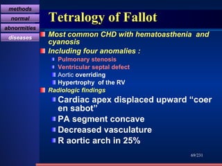 Tetralogy of Fallot Most common CHD with hematoasthenia  and cyanosis  Including four anomalies   : Pulmonary stenosis Ventricular septal defect Aortic  overriding Hypertrophy  of the RV Radiologic findings Cardiac apex displaced upward “coer  en sabot”  PA segment concave  Decreased vasculature  R aortic arch in 25% /231 methods normal abnormities diseases 