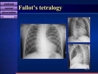 Fallot’s tetralogy /231 methods normal abnormities diseases 