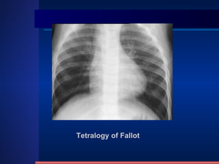 Tetralogy of Fallot 