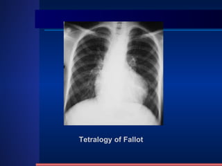Tetralogy of Fallot 