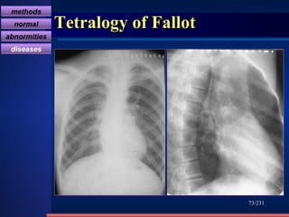 Tetralogy of Fallot /231 methods normal abnormities diseases 