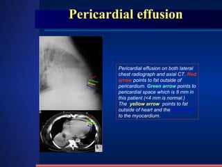 Pericardial effusion Pericardial effusion on both lateral chest radiograph and axial CT.  Red arrow  points to fat outside of pericardium.  Green arrow   points to pericardial space which is 8 mm in this patient (<4 mm is normal.)  The   yellow arrow    points to fat outside of heart and the  blue arrow  to the myocardium. 
