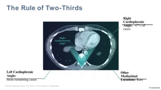 Pericardial_Cyst_Review/Pericardial_Cyst_Review.pptx