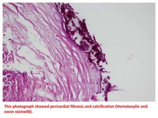 This photograph showed pericardial fibrosis and calcification (Hematoxylin and
eosin stainx40).
 