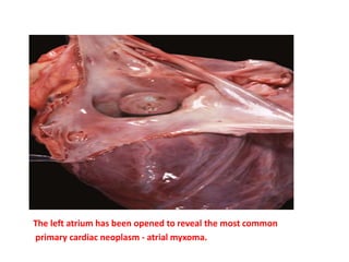 The left atrium has been opened to reveal the most common
primary cardiac neoplasm - atrial myxoma.
 