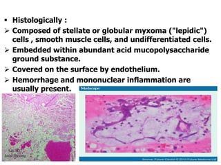  Histologically :
 Composed of stellate or globular myxoma ("lepidic")
cells , smooth muscle cells, and undifferentiated cells.
 Embedded within abundant acid mucopolysaccharide
ground substance.
 Covered on the surface by endothelium.
 Hemorrhage and mononuclear inflammation are
usually present.
 