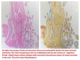 On light microscopy: fronds of connective tissue are eosinophilic (pink) and show minimal
cellularity. The most conspicuous cells are endothelial cells on the surface of "papillary"
fronds. (right) shows yellow collagen with concentric discontinous layers of elastic lamellae
in the core. Thus the name fibroelastoma
 